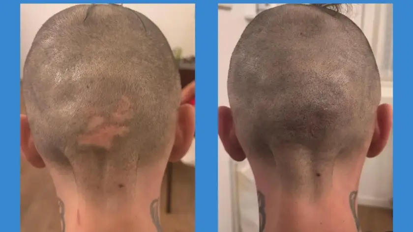 Tricopigmentazione su cicatrici